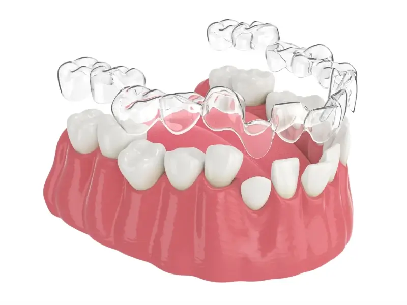 Invisalign czas leczenia